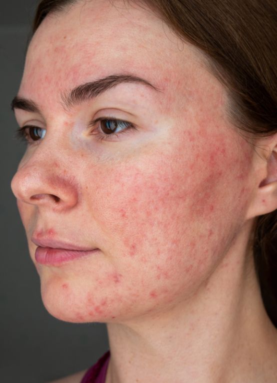 Best rosacea routine and tips